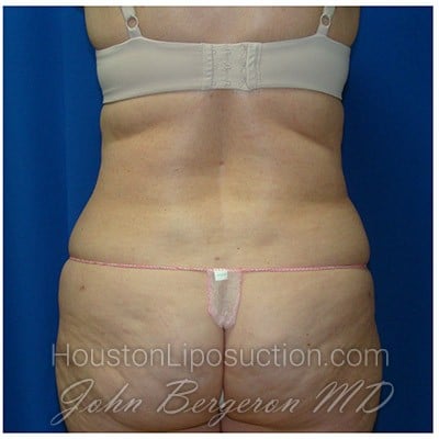 Liposuction after photo