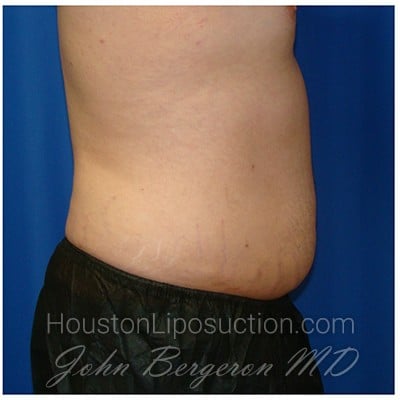 Liposuction after photo