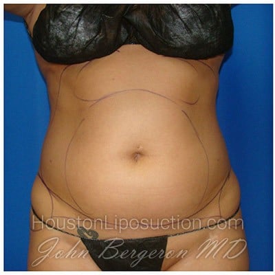 Liposuction before photo