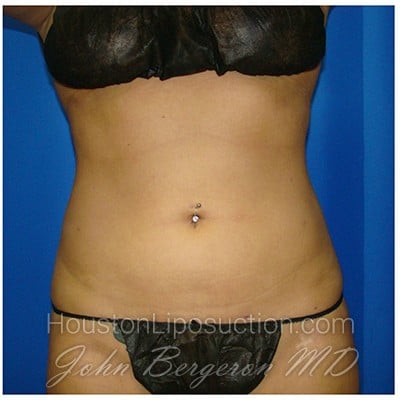 Liposuction after photo