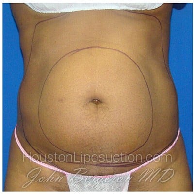 Liposuction before photo