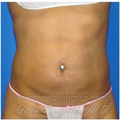 Liposuction after photo
