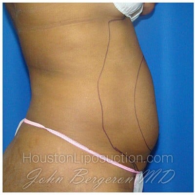 Liposuction before photo
