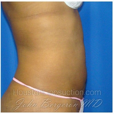 Liposuction after photo