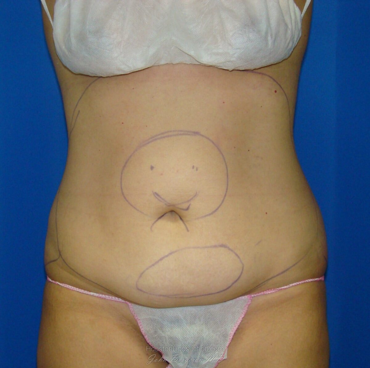 Liposuction before photo
