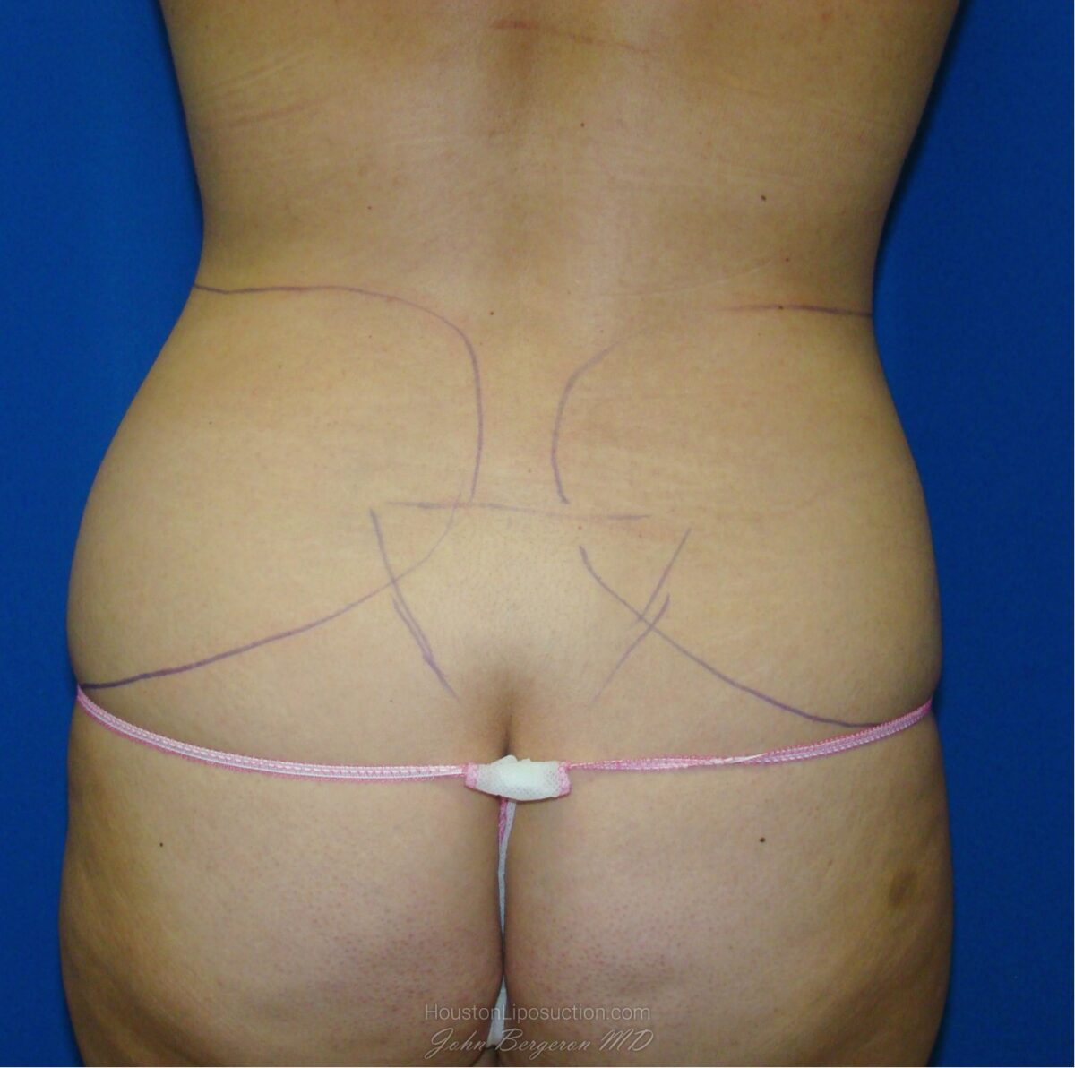 Liposuction before photo