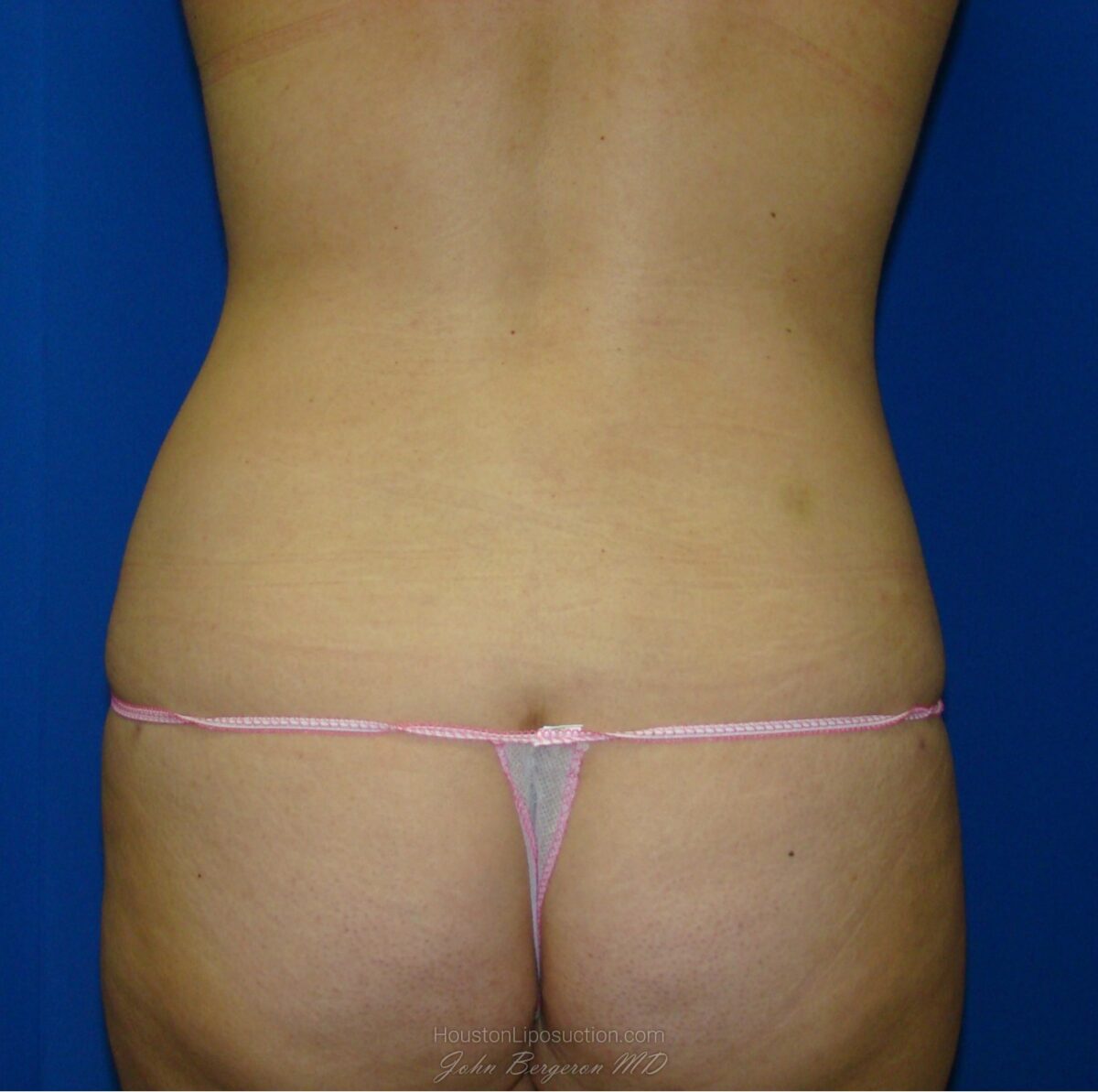 Liposuction after photo