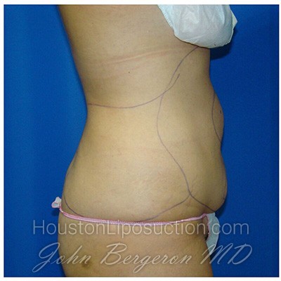 Liposuction before photo