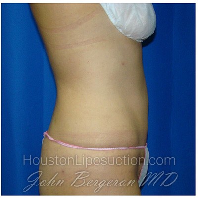 Liposuction after photo