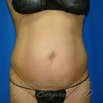 Liposuction before photo