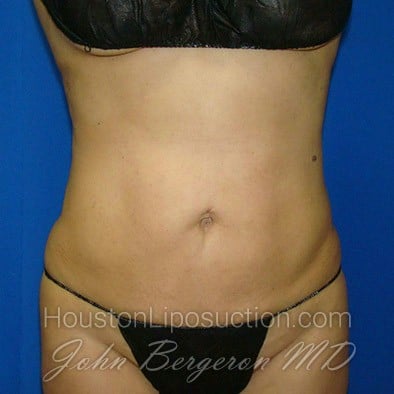 Liposuction after photo