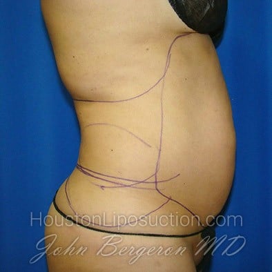 Liposuction before photo