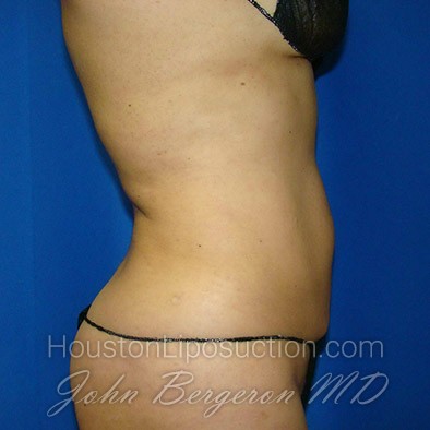 Liposuction after photo