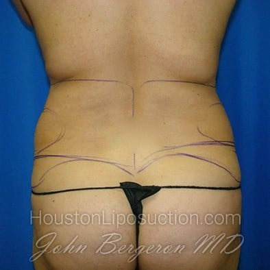 Liposuction before photo
