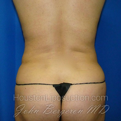 Liposuction after photo