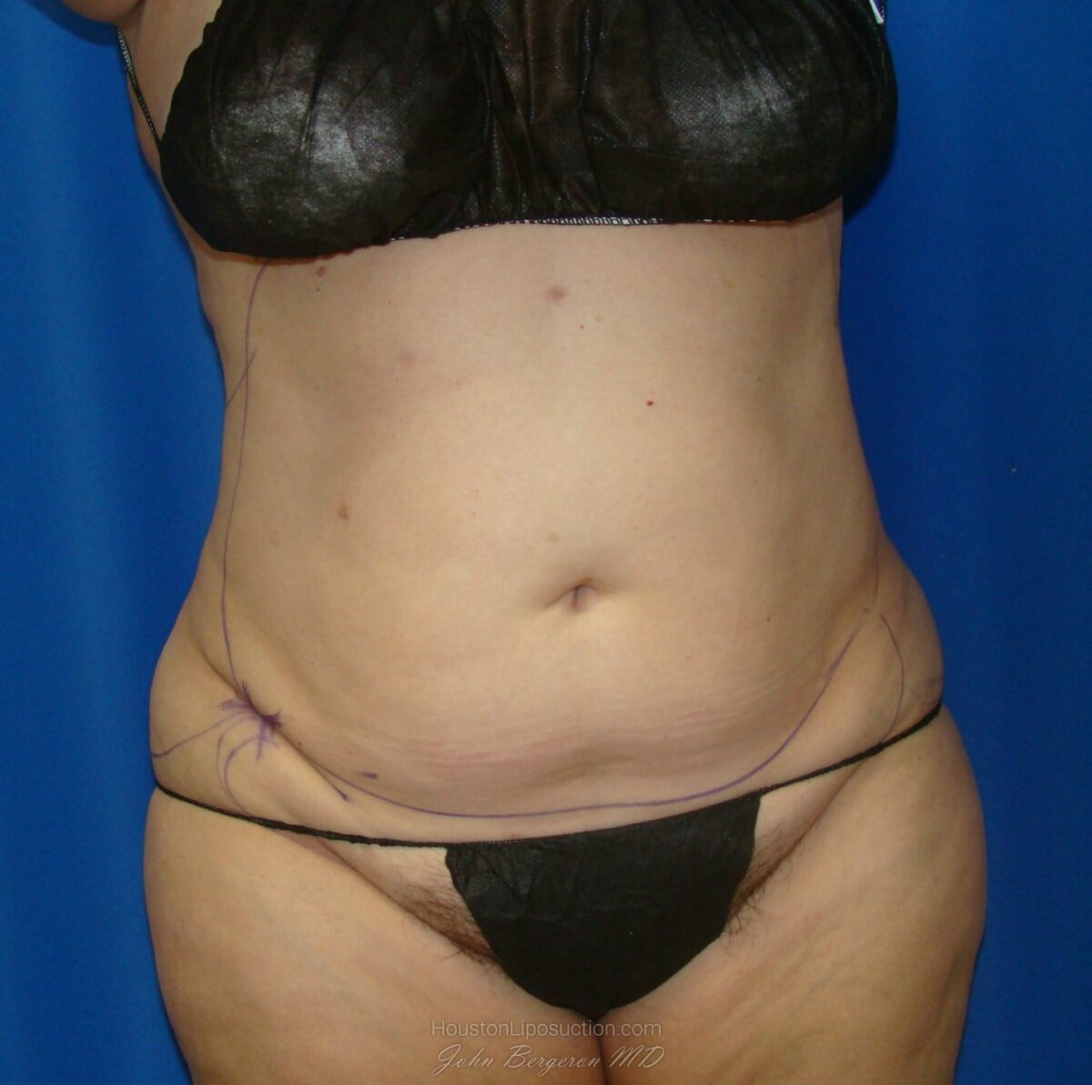 Liposuction before photo