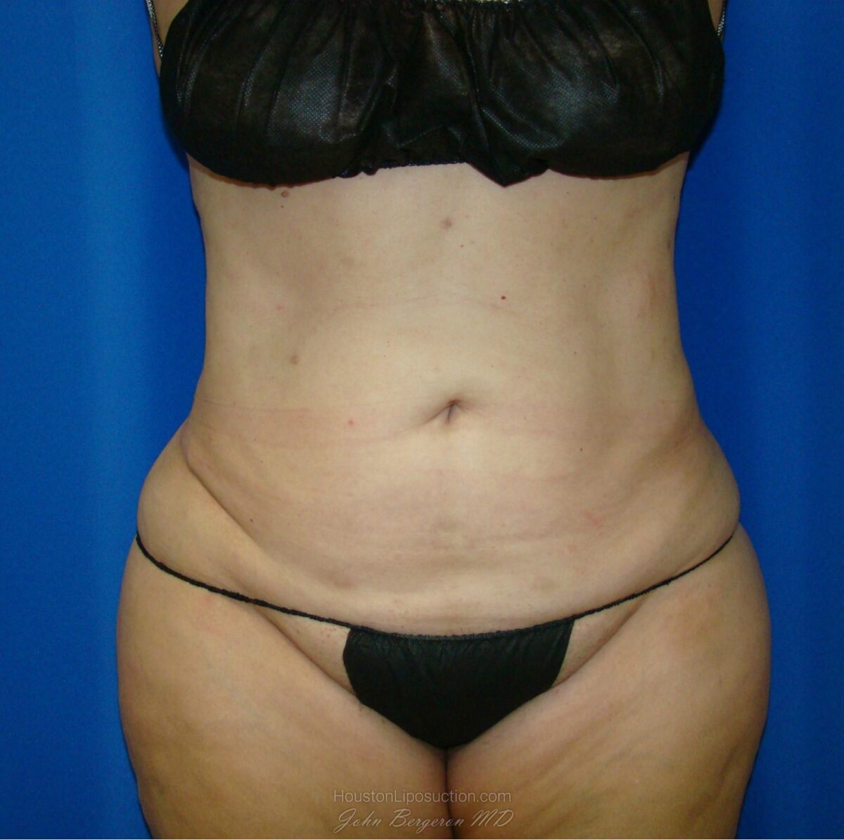 Liposuction after photo