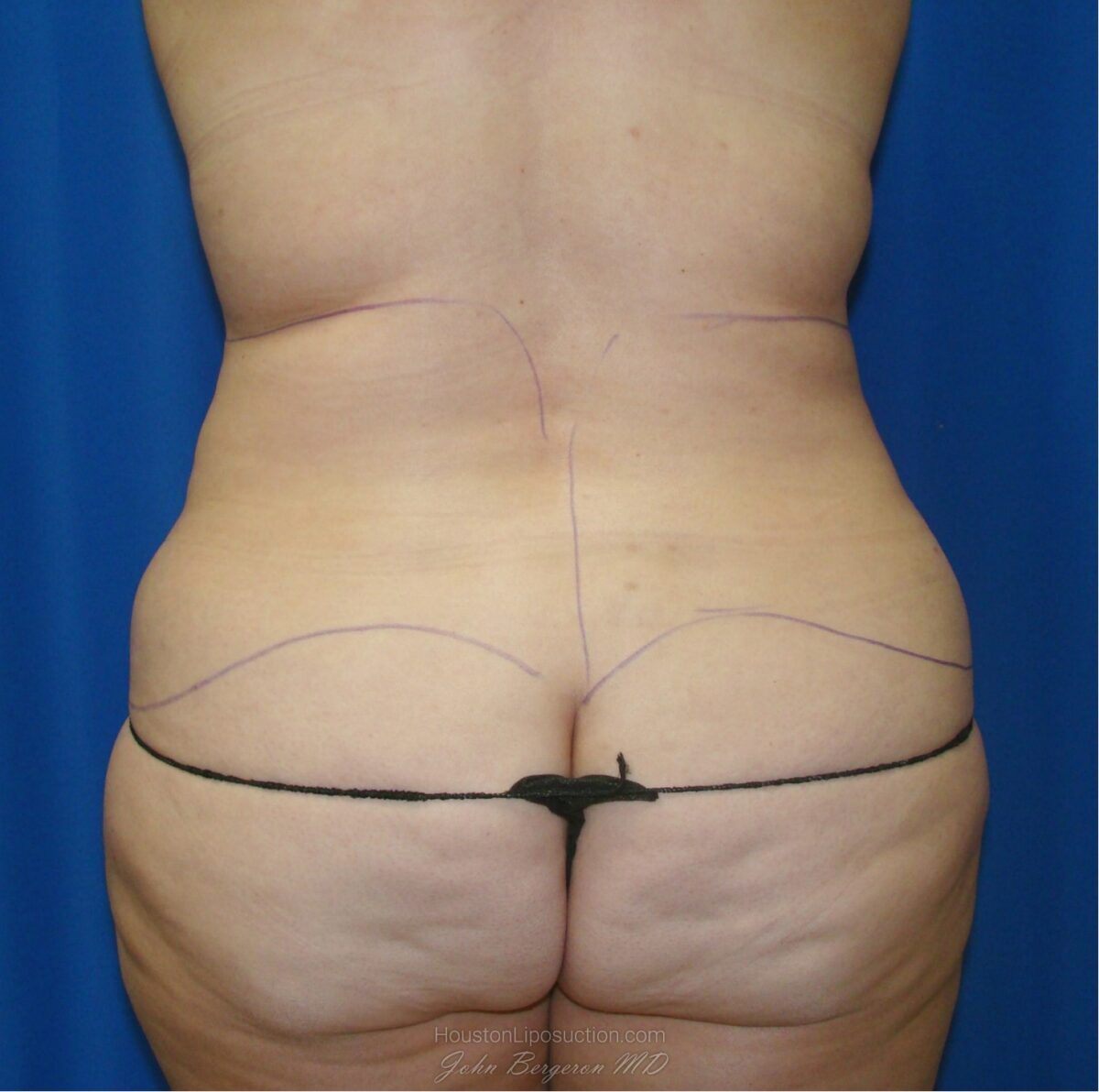 Liposuction before photo