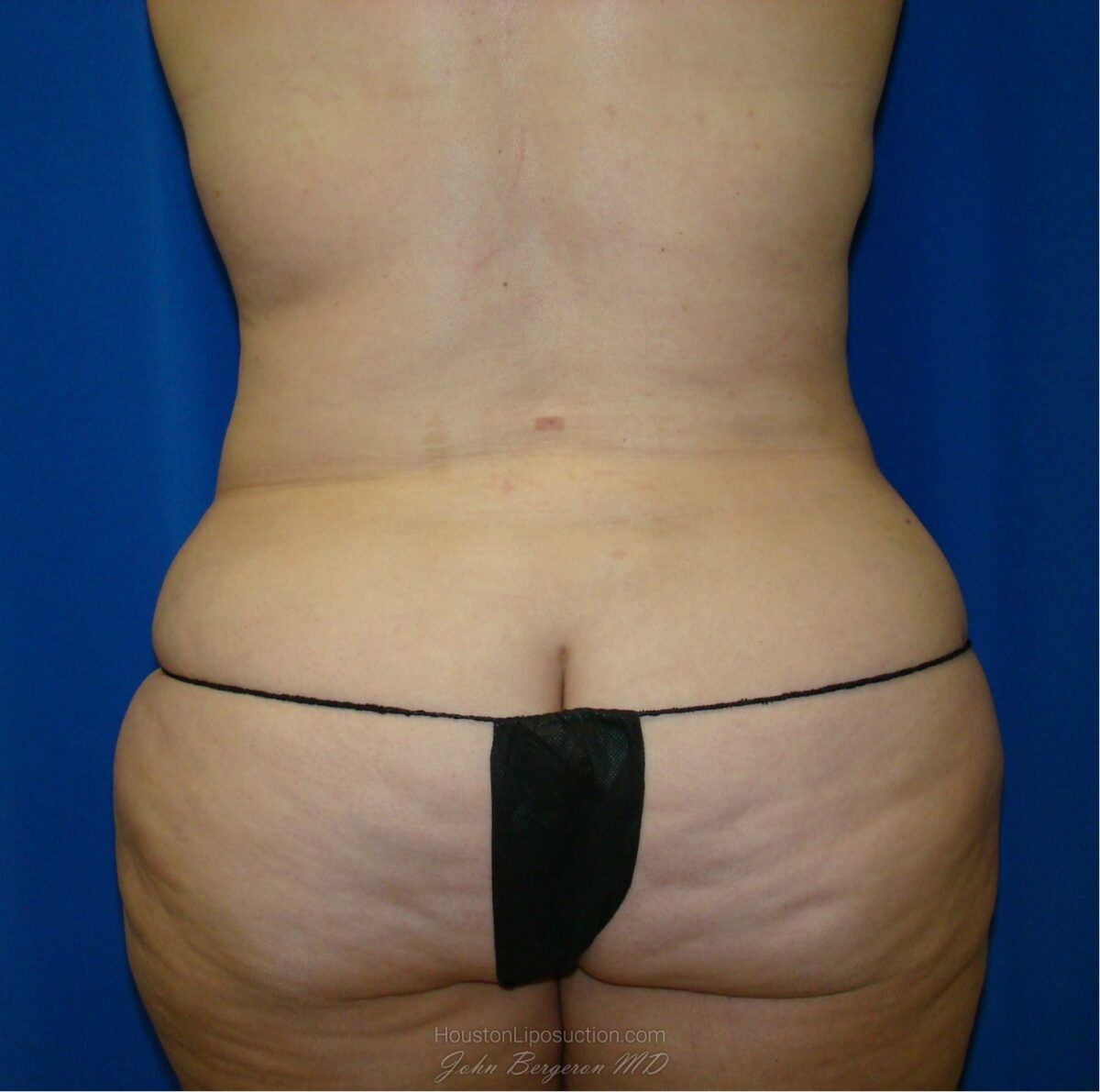 Liposuction after photo