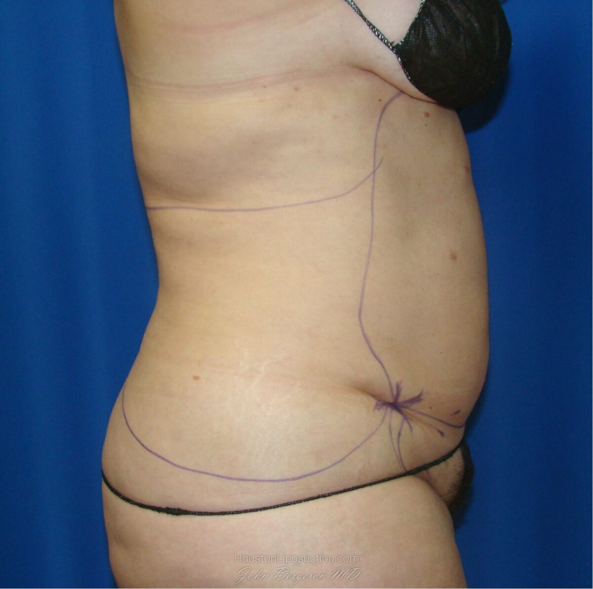 Liposuction before photo