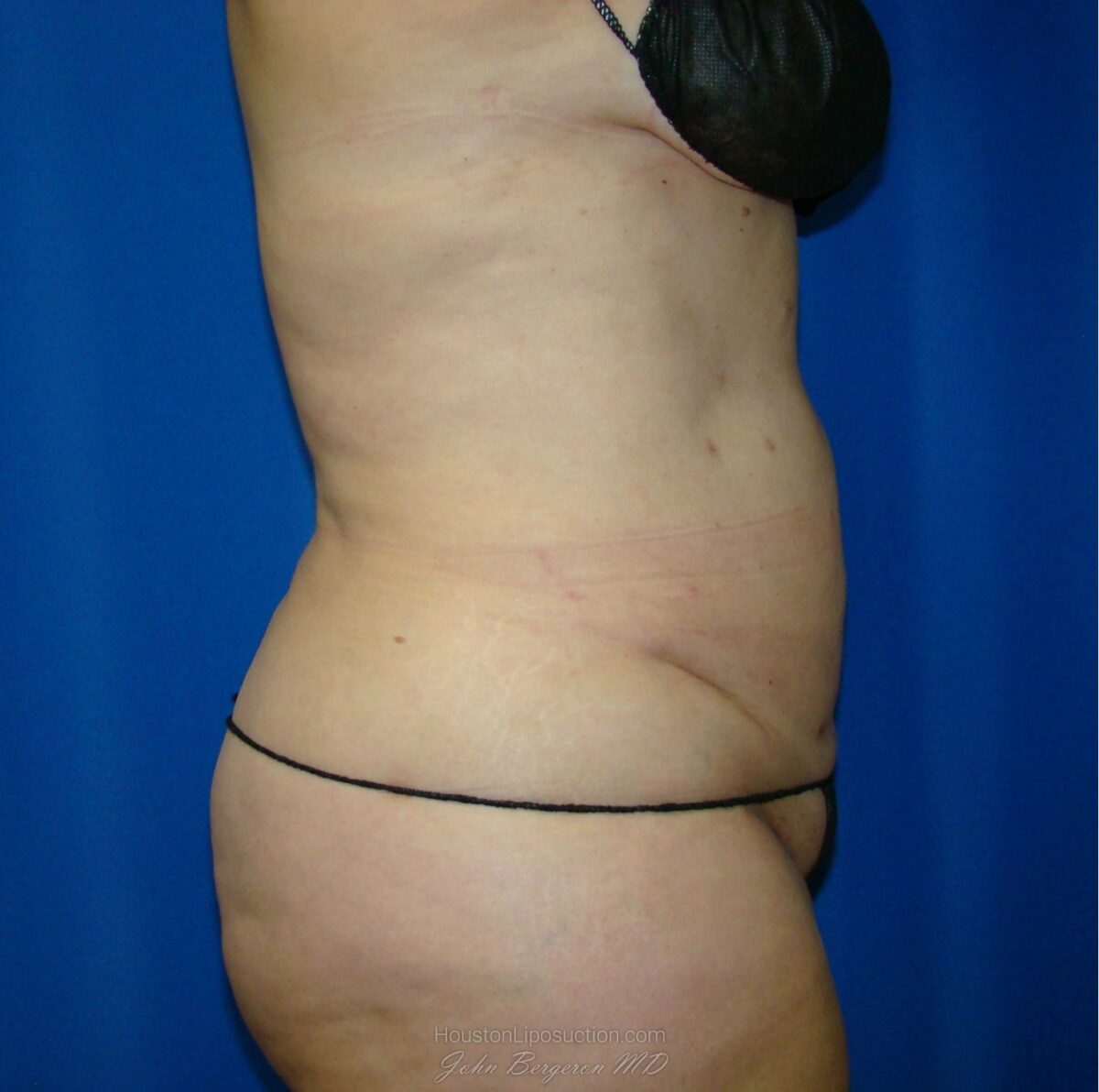 Liposuction after photo