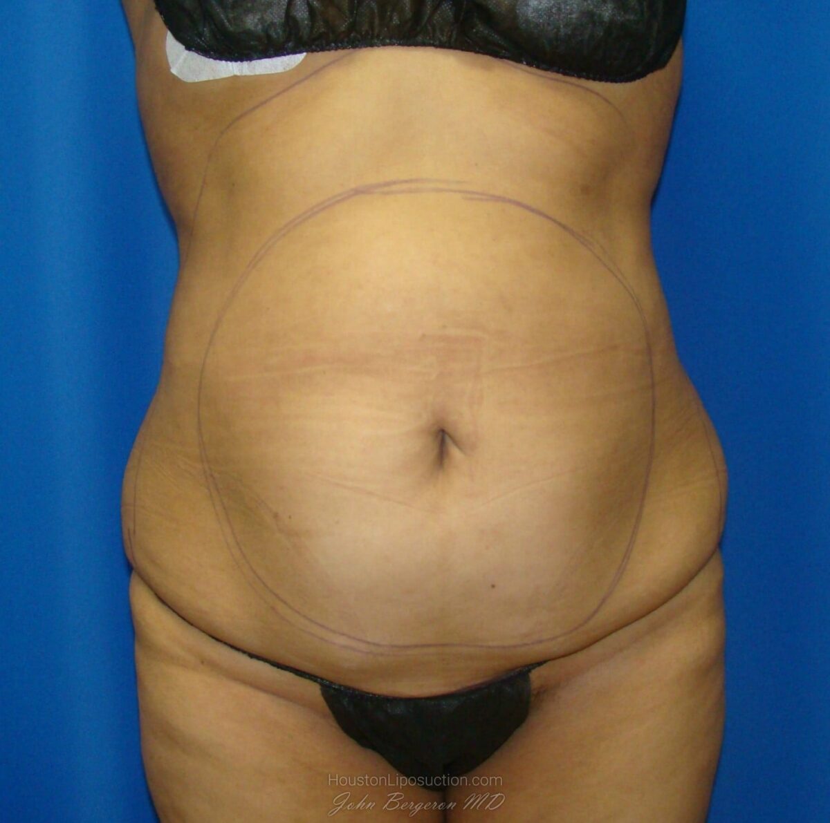 Liposuction before photo