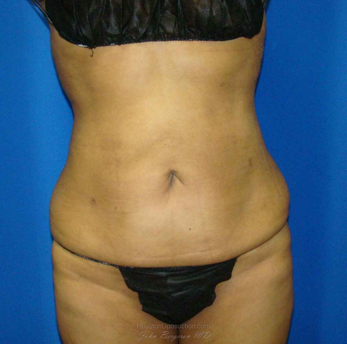 Liposuction after photo