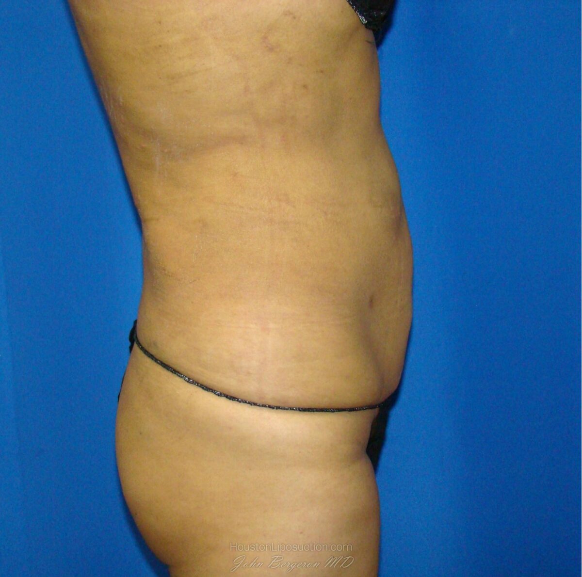 Liposuction after photo