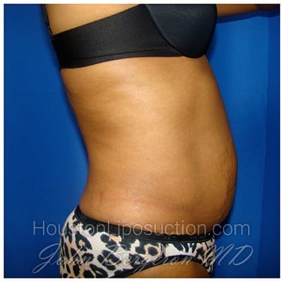 Liposuction before photo