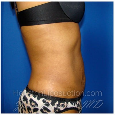 Liposuction after photo