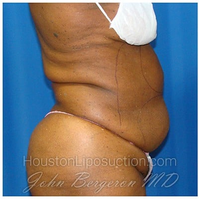 Liposuction before photo