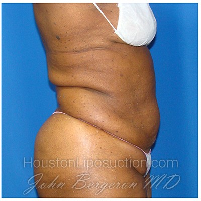 Liposuction after photo