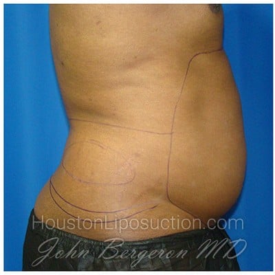 Liposuction before photo