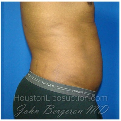 Liposuction after photo