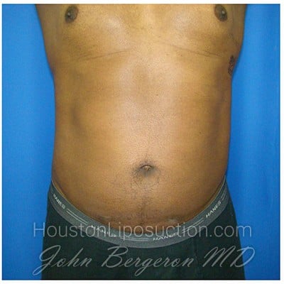 Liposuction after photo