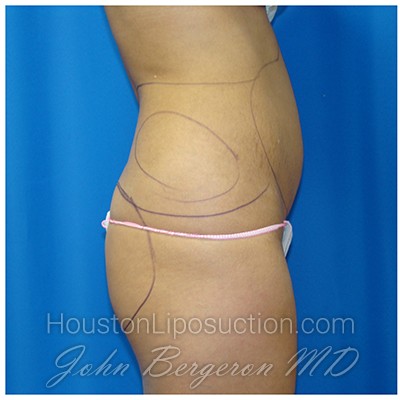 Liposuction before photo