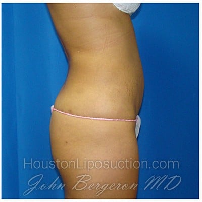 Liposuction after photo