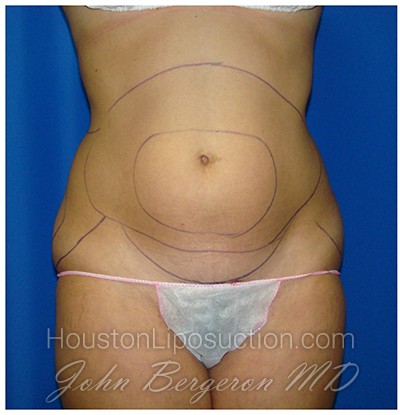 Liposuction before photo