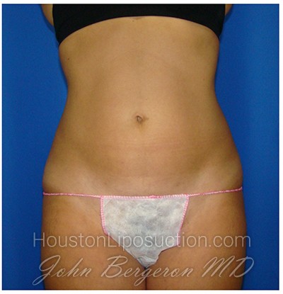 Liposuction after photo