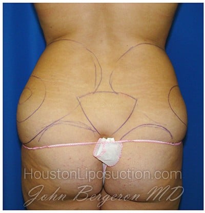 Liposuction before photo
