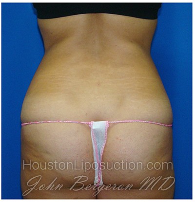 Liposuction after photo