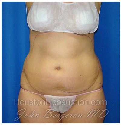 Liposuction before photo