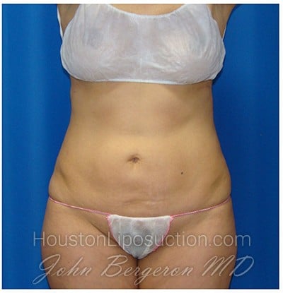 Liposuction after photo