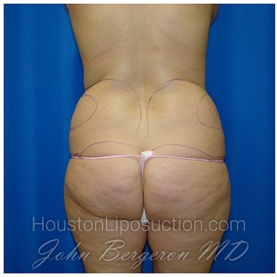 Liposuction before photo