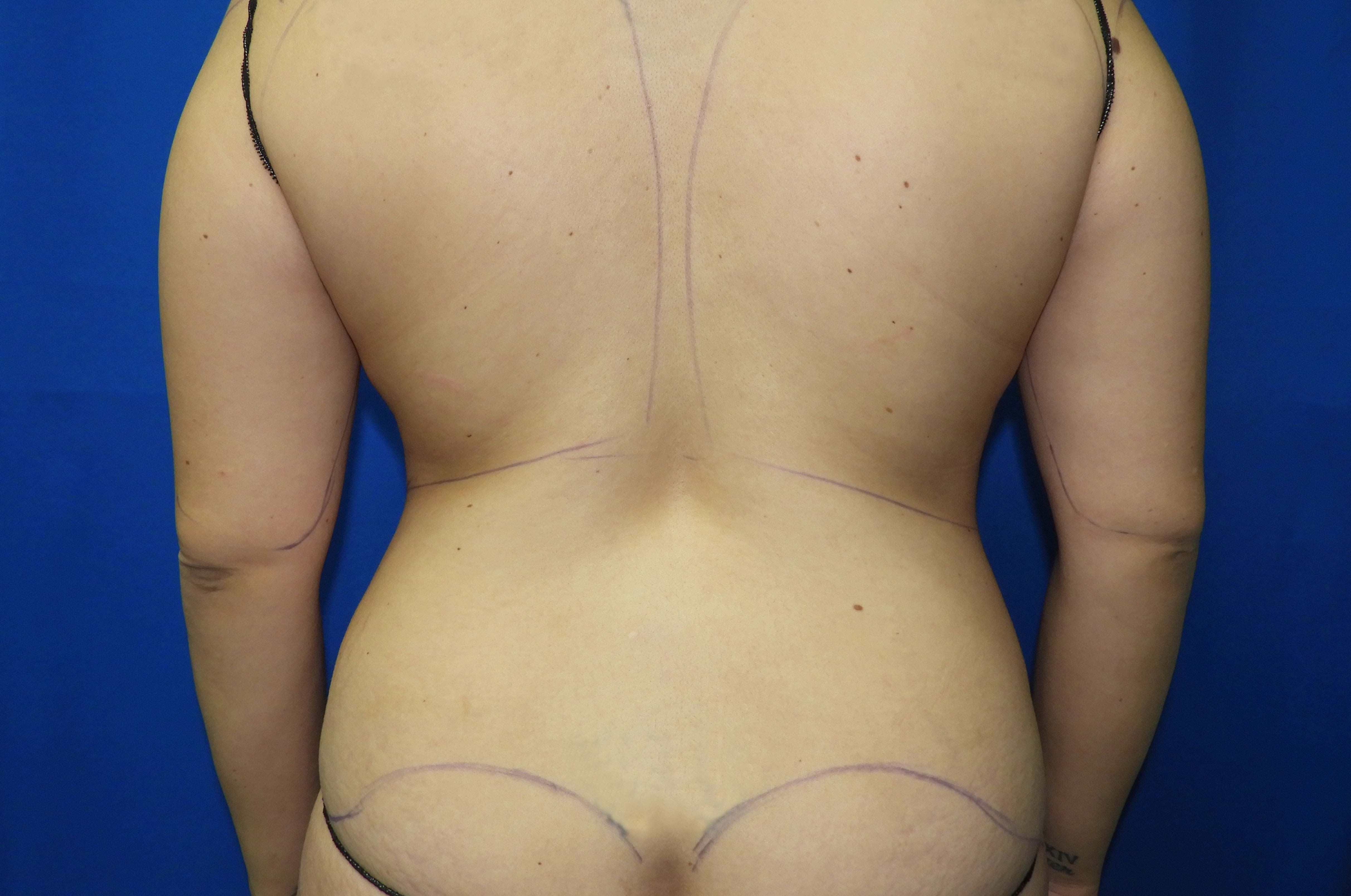 Liposuction before photo