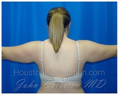 Liposuction before photo