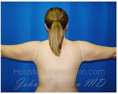Liposuction after photo