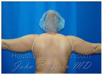 Liposuction before photo