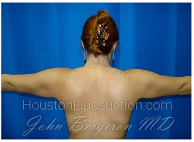 Liposuction after photo