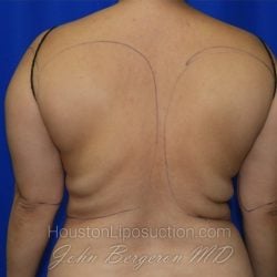 Liposuction before photo
